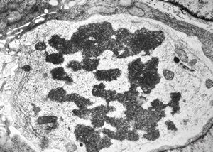 F,35y. | mitosis - intestine, celiakia